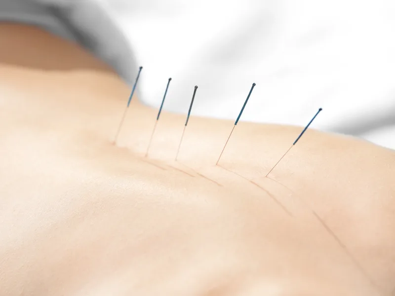 Acupuncture at Live Well Family Chiropractic in Houston