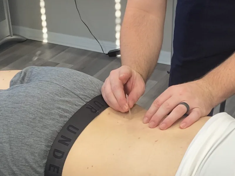 How Dry Needling works at Live Well Family Chiropractic
