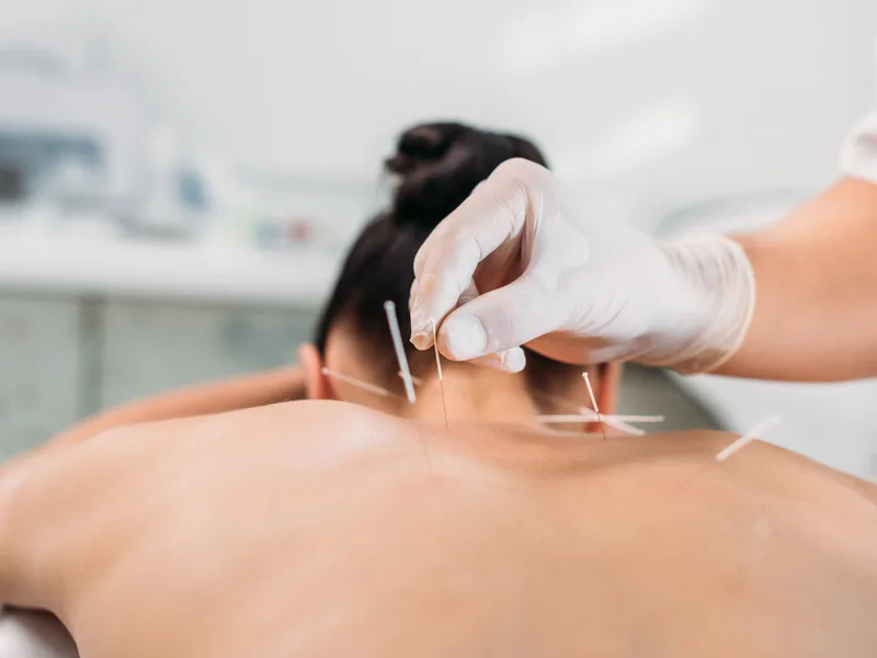 Dry Needling at Live Well Family Chiropractic in Houston